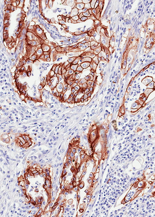 TROP2 expression in human endometrial carcinoma